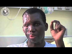 Pastor Umar Mulinde po ataku kwasem przez wyznawców islamu